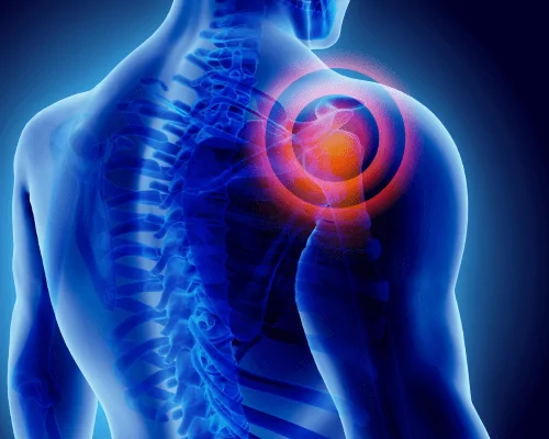 3D medical illustration of a human torso with a glowing red pain indicator on the shoulder joint.