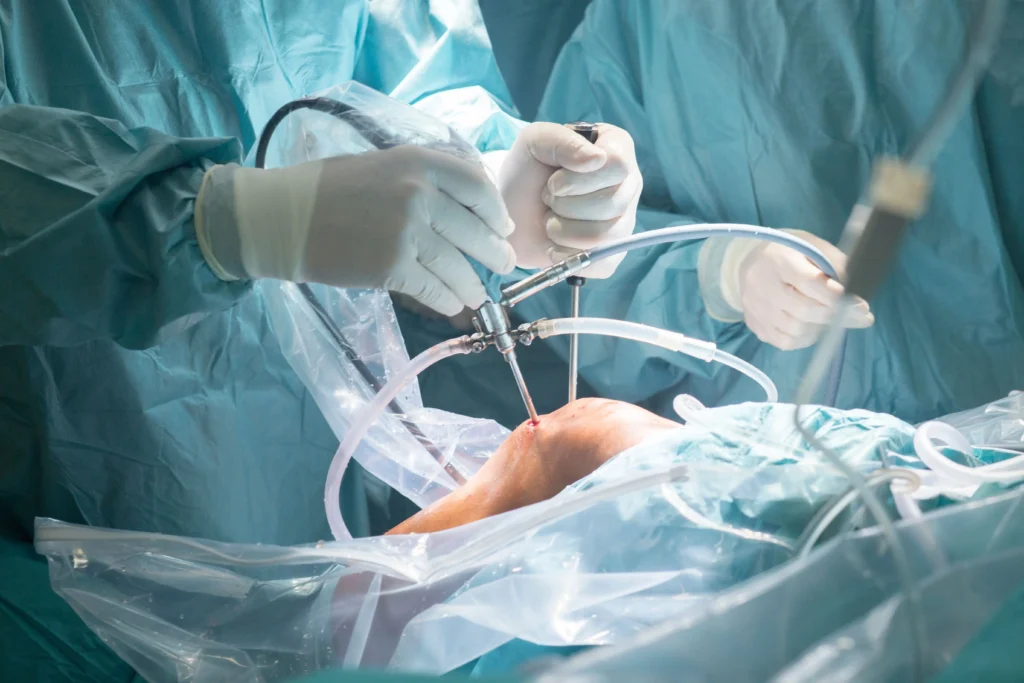 Surgeons performing a minimally invasive arthroscopic knee procedure.