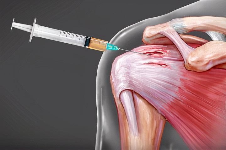 Medical illustration of a syringe injecting fluid into a human shoulder joint.