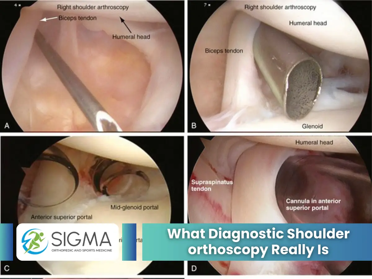 What Diagnostic Shoulder orthoscopy Really Is